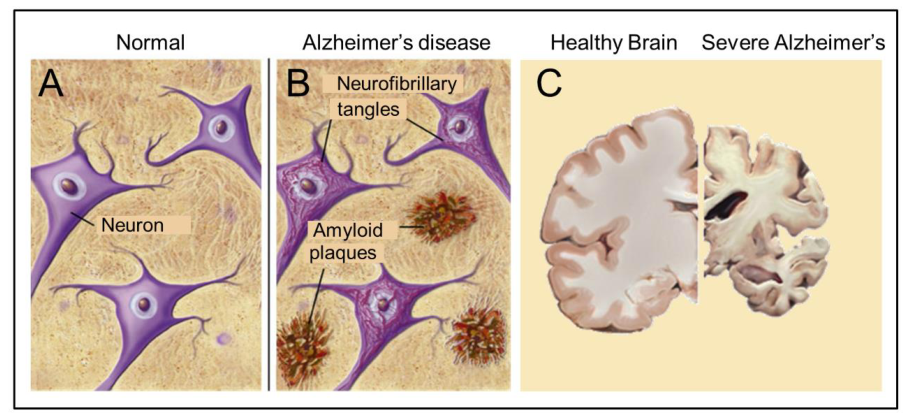 阿爾茨海默病的神經(jīng)基礎